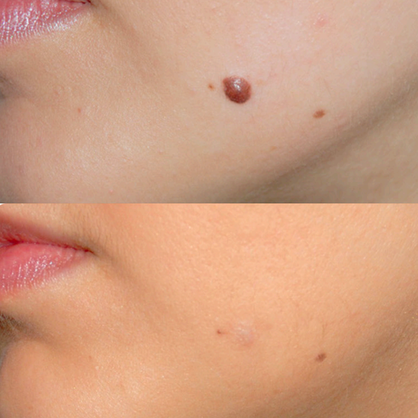 CryoPen The Nimmo Clinic Aesthetics Before After Cobham Surrey 3