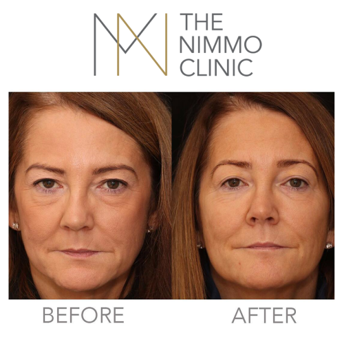 Nimmo Clinic Before And After Chelsea Surrey London Nimmo Clinic Before And After Surrey